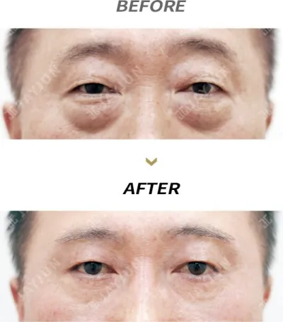 Before & After