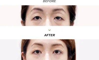 Before & After