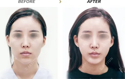 Before & After