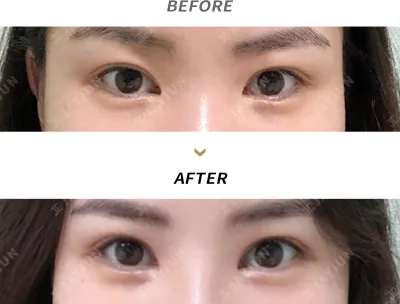Before & After