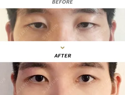 Before & After