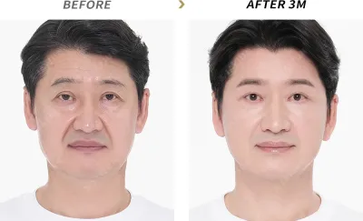 Before & After