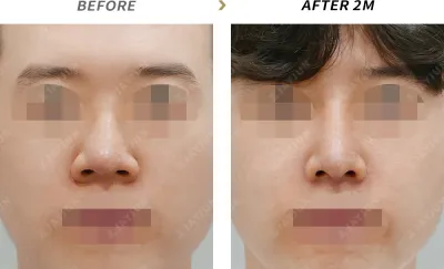 Before & After