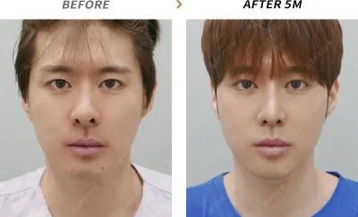 Before & After