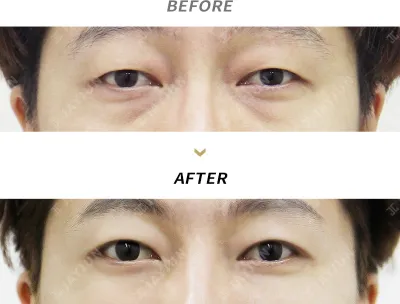 Before & After