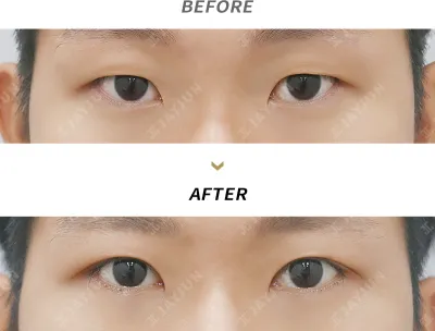 Before & After
