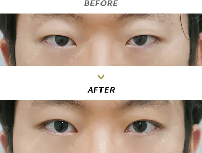 Before & After