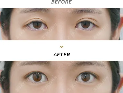 Before & After