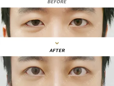 Before & After
