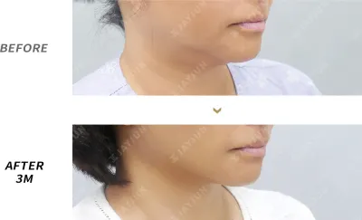 Before & After