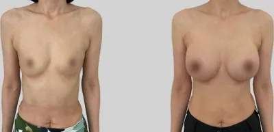 Before & After