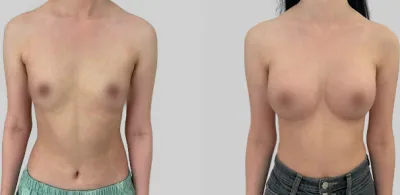 Before & After
