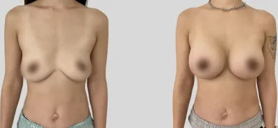 Before & After