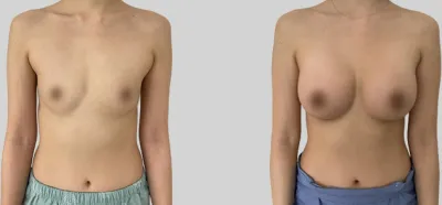 Before & After