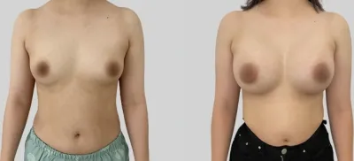 Before & After