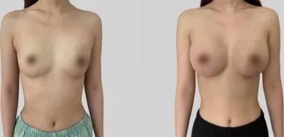 Before & After