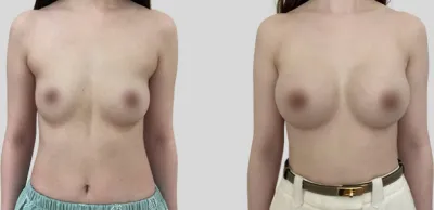 Before & After