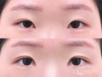 Before & After