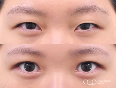 Before & After