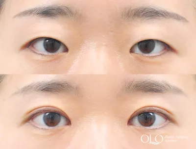 Before & After