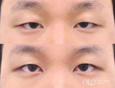 Before & After