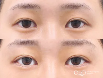Before & After