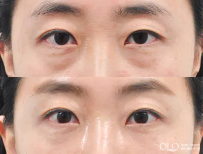 Before & After