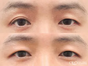 Before