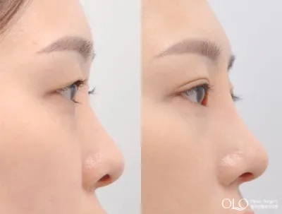 Before & After