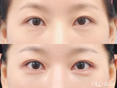 Before & After