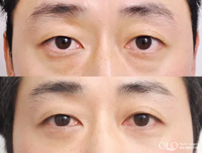 Before & After