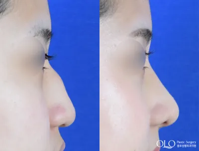 Before & After