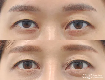 Before & After