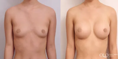 Before & After