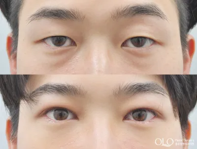 Before & After