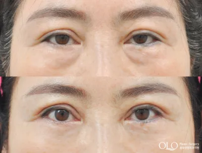 Before & After