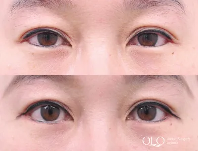 Before & After