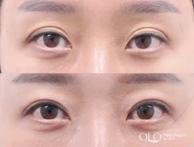 Before & After