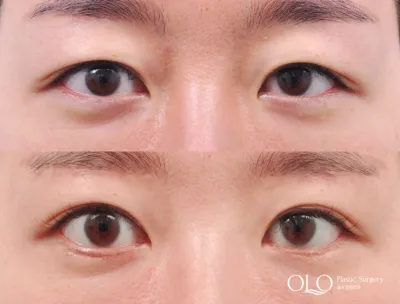 Before & After