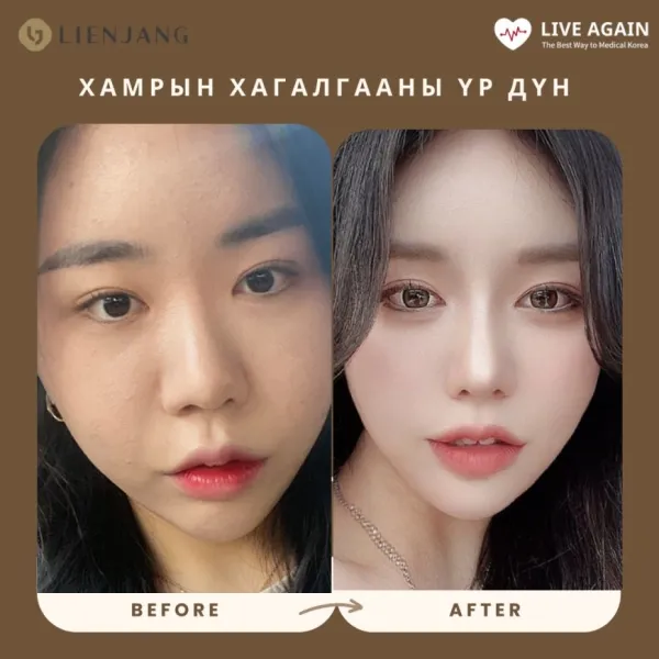Хамрын мэс засал  Before & After