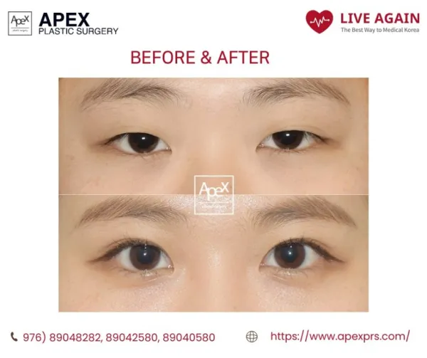 " Apex " Гоо сайхны мэс заслын эмнэлэг  Before & After 