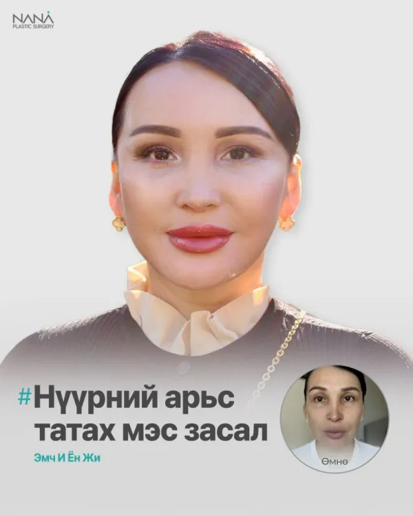 NANA Арьс татах мэс засал, Дээд, доод зовхи татах мэс засал, Нүүрэнд өөх суулгах мэс заслын дараах өөрчлөлт
