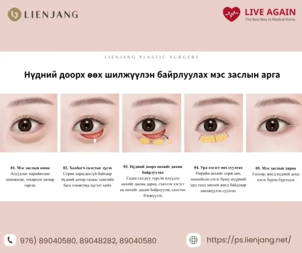 💎 3 Алхамт Нүдний Доорх Өөх Шилжүүлэн Байрлуулах Мэс Засал
