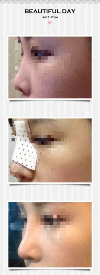 鼻手術後第十天了！！！