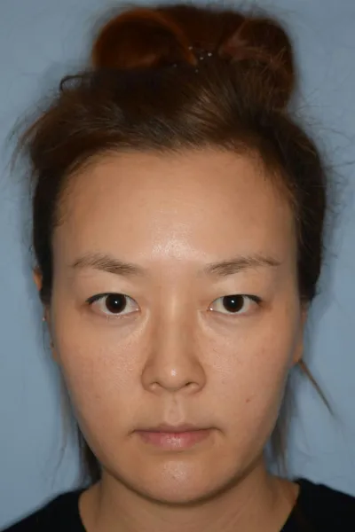 手術已經過了3個月了。到處仔細打聽醫院、親自去拜訪、也諮詢過... 但沒什麼特別心動的感覺。因為當時對於要不要動手術的信心只有一半一半，擔心萬一弄不好會出現副作用...