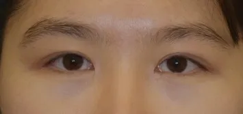 終於做了非切開提眼肌手術了哈哈哈哈哈