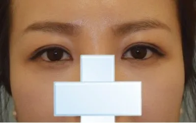 因為雙眼皮總是散掉，經過一番苦惱後