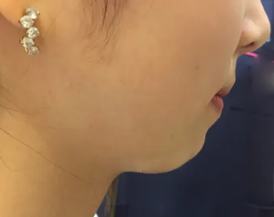 因為我的下巴後縮很嚴重，所以一開始也考慮過做下巴矯正手術。