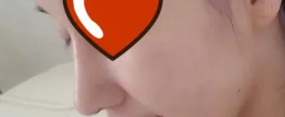 高考結束後，和朋友一起做了鼻子手術。