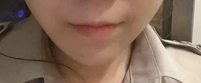 院長您好嗎？我是之前做過下顎角手術的恩靜。